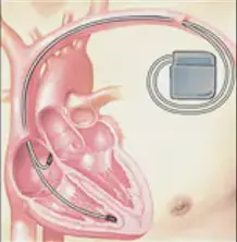 細數(shù)心臟起搏器和ICD之間的差異